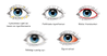 Bilder röda ögon demodex torra ögon